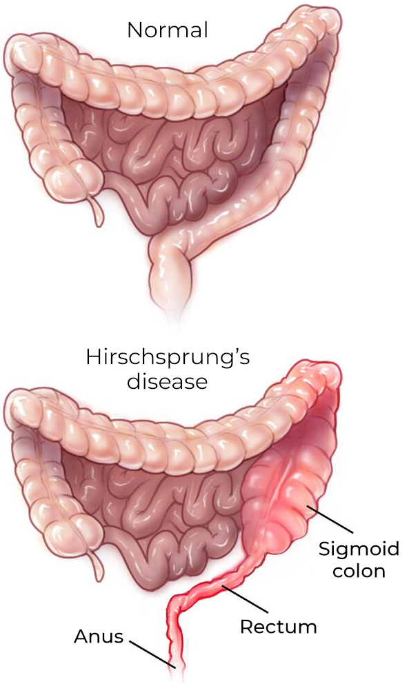 Hirschsprung disease